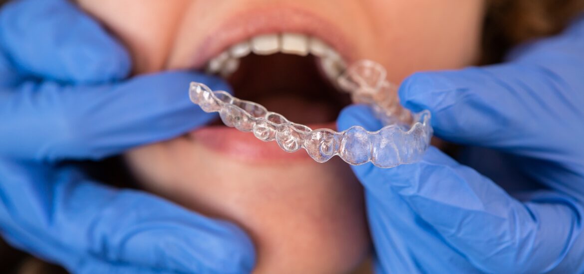 Close-up of an orthodontic specialist adjusting and placing invisible aligners on a caucasian woman