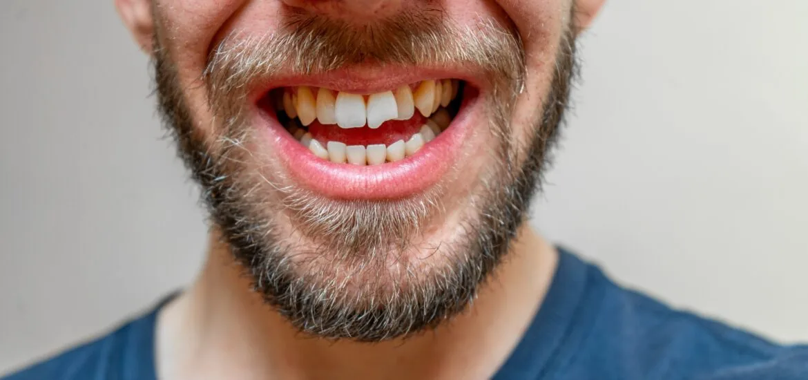 close up of a broken tooth, young man smiling