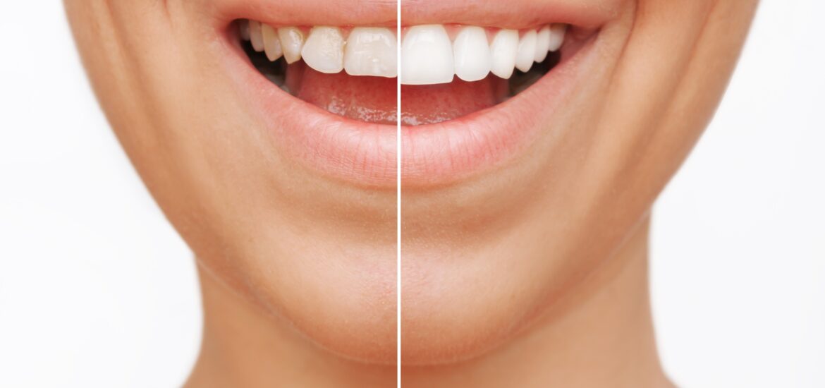 cropped shot, before and after dental veneers