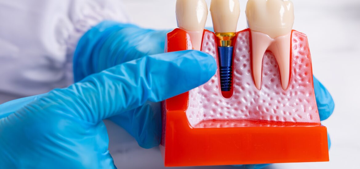 dentist in blue gloves showing an implant model